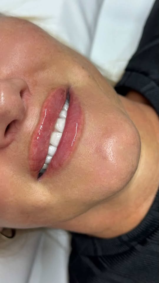 Lip treatment result