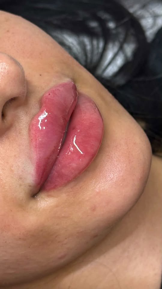 Lip treatment result